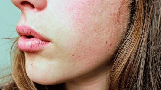 Närbild på hud med stora porer före microneedling