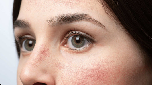 Rodnad och irritation i ansiktet efter microneedling, exempel på vanlig hudreaktion efter dermaroller eller dermapen.